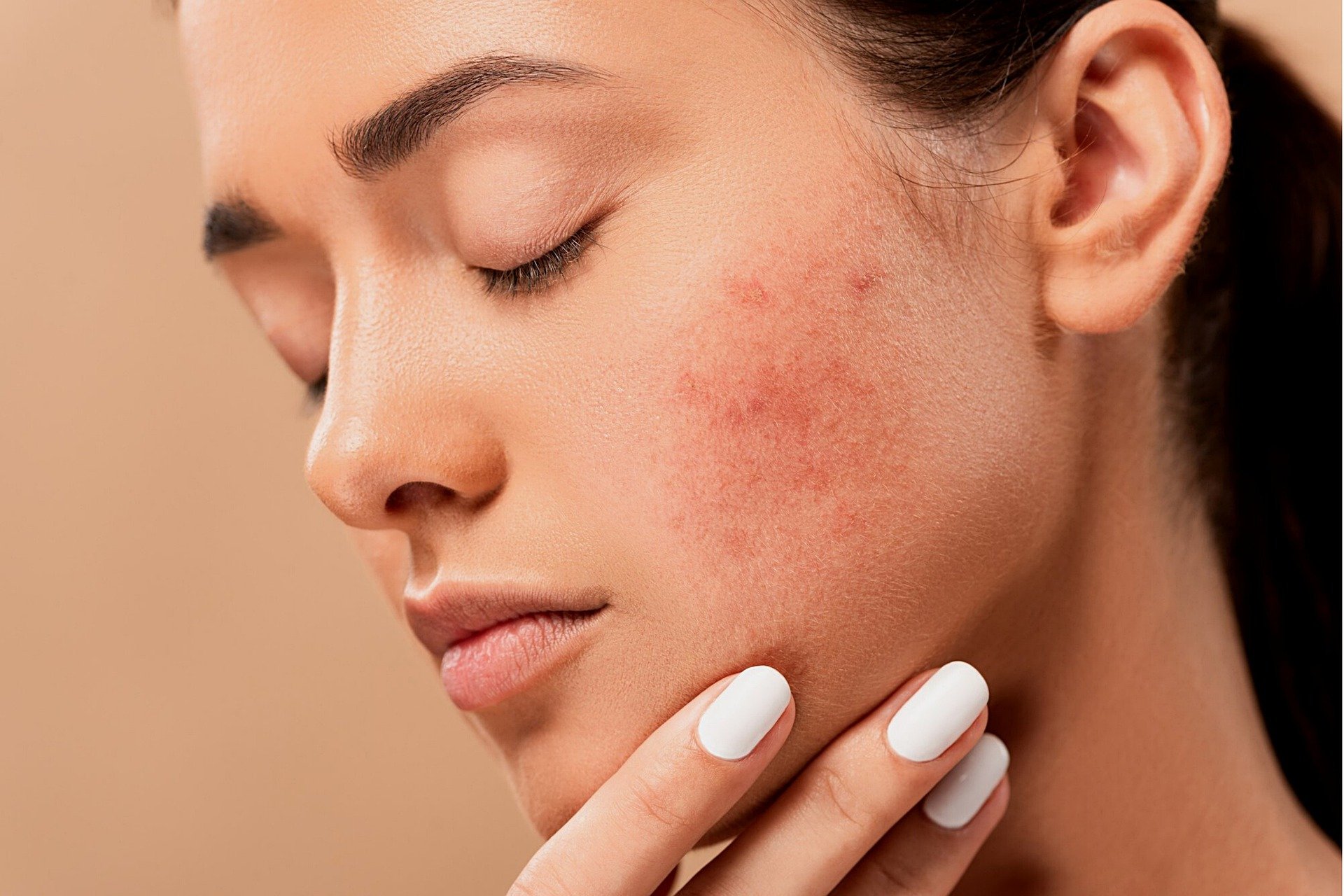 acne-5561750_1920 (1)